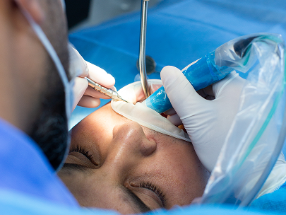 Blog1-Root-Canal