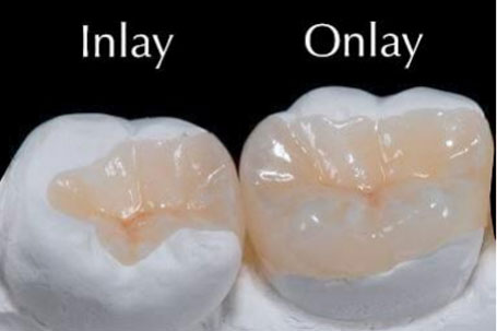 Inlay-outlay